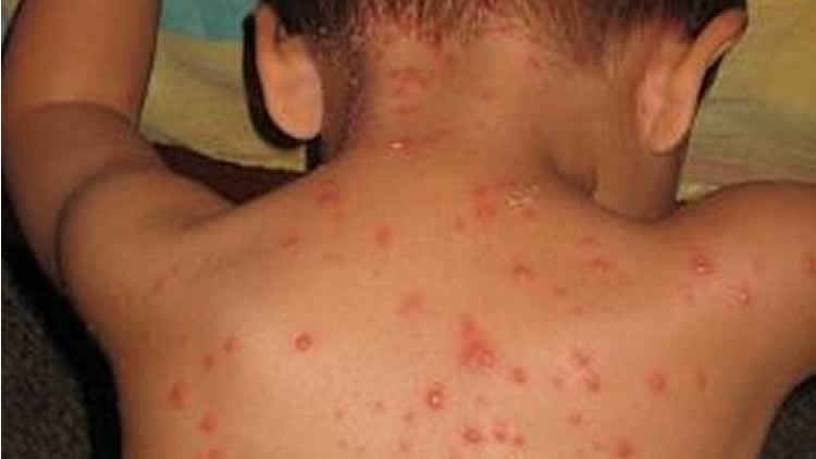 Aumentan casos de varicela en Beni